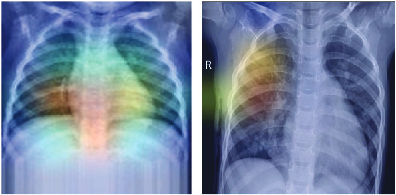 Optical Based Gradient-Weighted Class Activation Mapping and Transfer Learning Integrated Pneumonia Prediction Model
